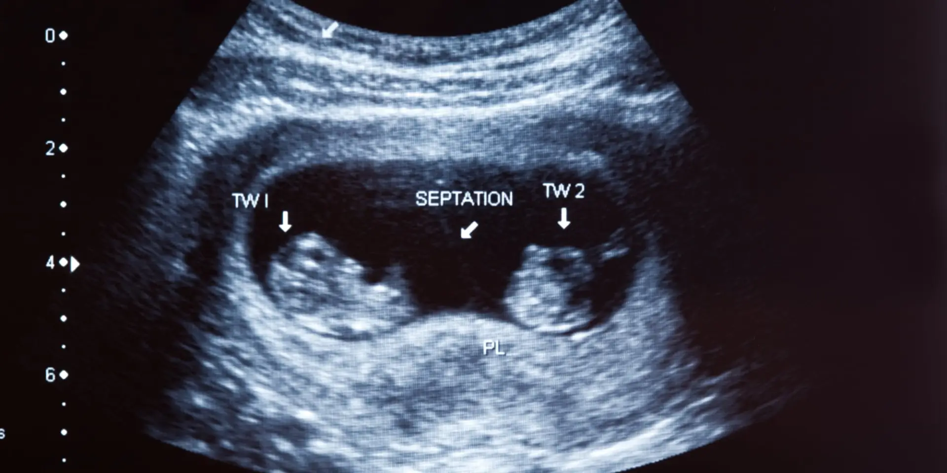 Ultrasound scan of a twin pregnancy showing two fetuses labelled TW 1 and TW 2 with a membrane between them